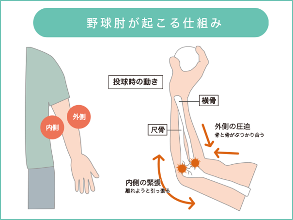 野球肘の治療 東京でお探しなら武蔵村山市やまかわ整骨院へ
